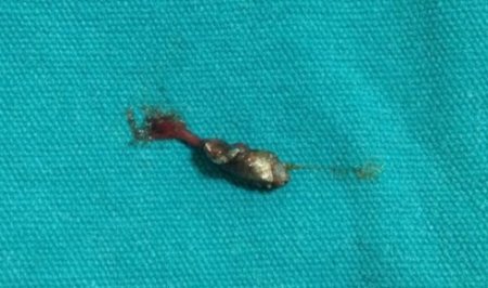 Polis vurdu denildi, vücutlarında el yapımı bombanın şarapnel parçaları çıktı