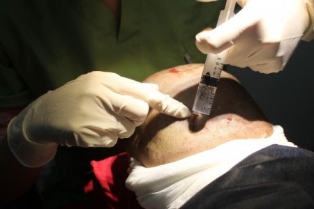 Saçı dökülen Araplar İstanbul'a koşuyor