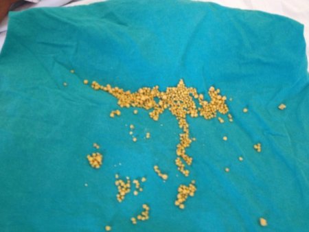 Safra Kesesinden 466 Taşı Çıktı