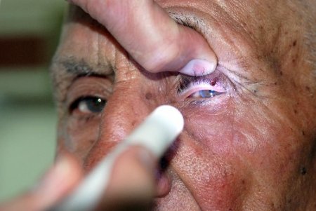 Şiş ve ağrı var diye geldi, gözünden kene çıkarıldı