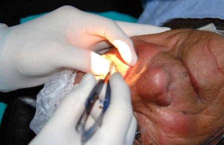 Şiş ve ağrı var diye geldi, gözünden kene çıkarıldı