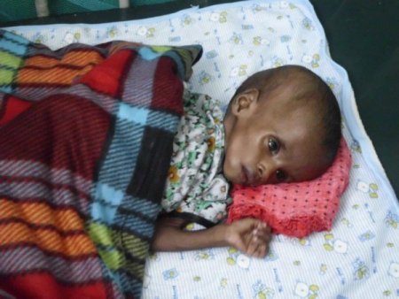 Somali’de Esafed’in Yaşam Nöbeti Balıkesirli Gönüllü Doktorlarla Devam Ediyor