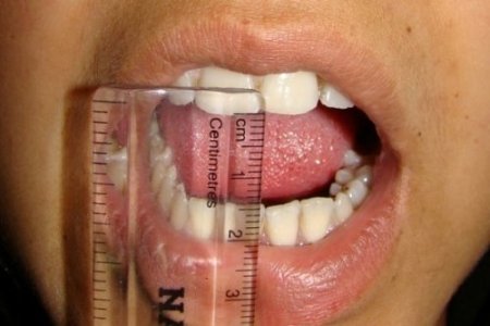 Stres, kadınlarda çeneyi düşürüyor