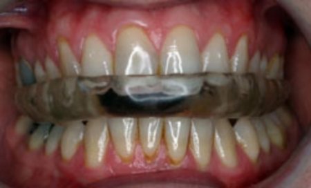 Stres, kadınlarda çeneyi düşürüyor