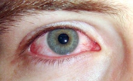 Uzmanlardan bulaşıcı hastalık uyarısı: Elinizi gözünüze sürmeyin!