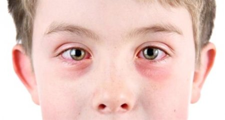 Uzmanlardan bulaşıcı hastalık uyarısı: Elinizi gözünüze sürmeyin!