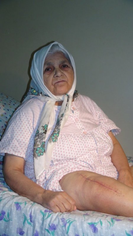Yanlış bacağa protez takıldı iddiası (Özel)