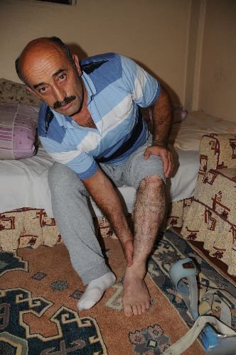 Yanlış İğneden Sakat Kaldı, Sağlık Bakanlığı Aleyhine 100 Bin Liralık Tazminat Davası Açtı