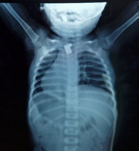 Yemek borusuna takılı anahtar parçası bulundu