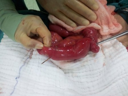 Yemek sonrası yuttuğu kürdan bağırsaklarını deldi