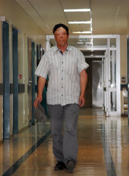 Yüz Nakli Olan Çolak'ın Ailesine, Bakan Binali Yıldırım'dan Destek