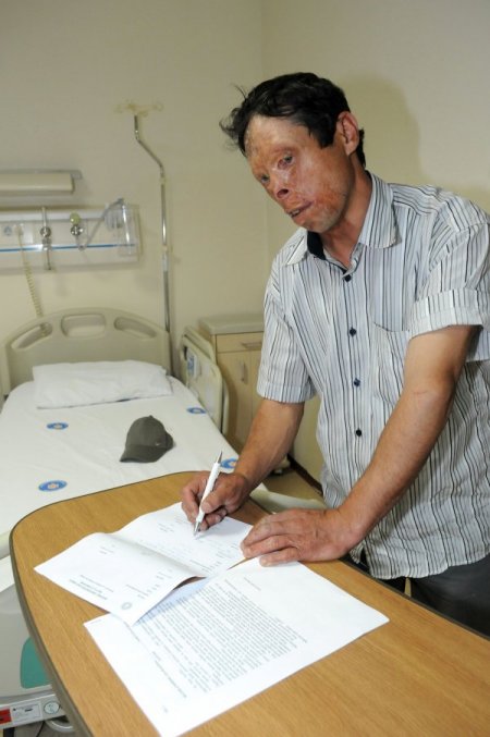 Yüz Nakli Olan Çolak'ın Ailesine, Bakan Binali Yıldırım'dan Destek