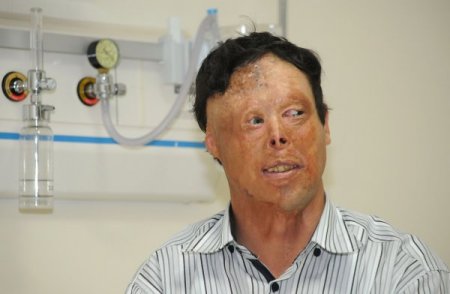 Yüz Nakli Olan Çolak'ın Ailesine, Bakan Binali Yıldırım'dan Destek